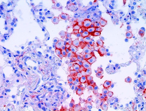 IHC of B7H3 / CD276 on an FFPE Lymphoblastic Lymphoma Tissue